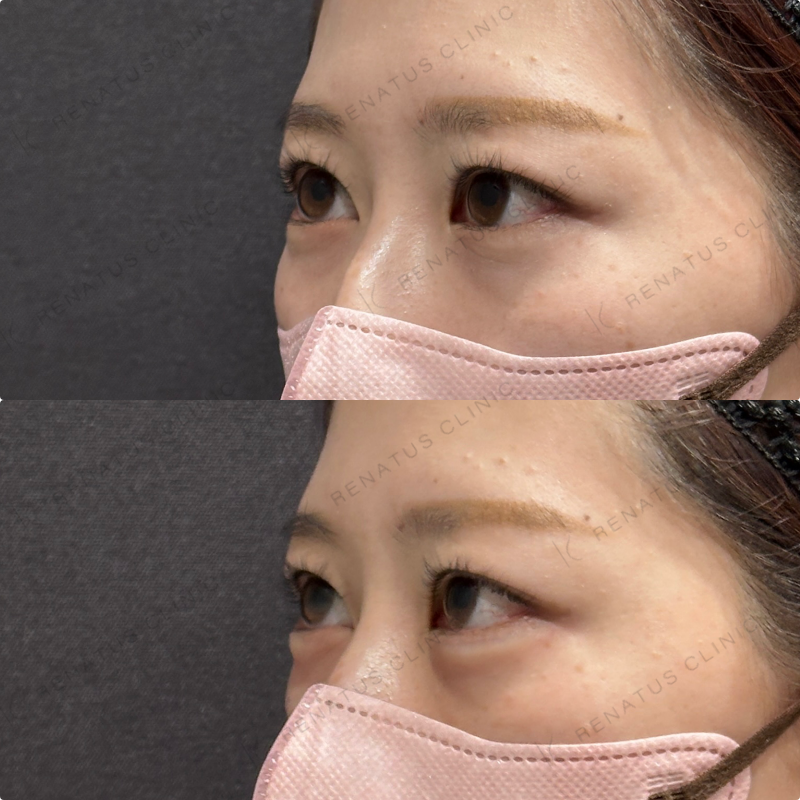 涙袋ヒアルロン酸ボルベラ症例写真