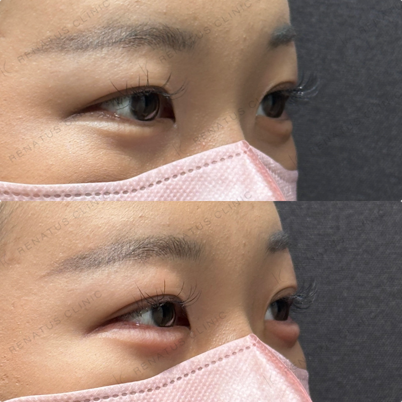 涙袋ヒアルロン酸ボルベラ症例写真