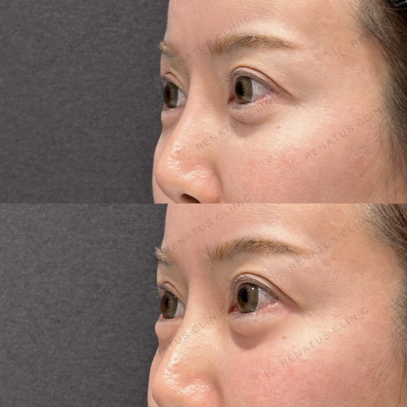 涙袋ヒアルロン酸ボルベラ症例写真