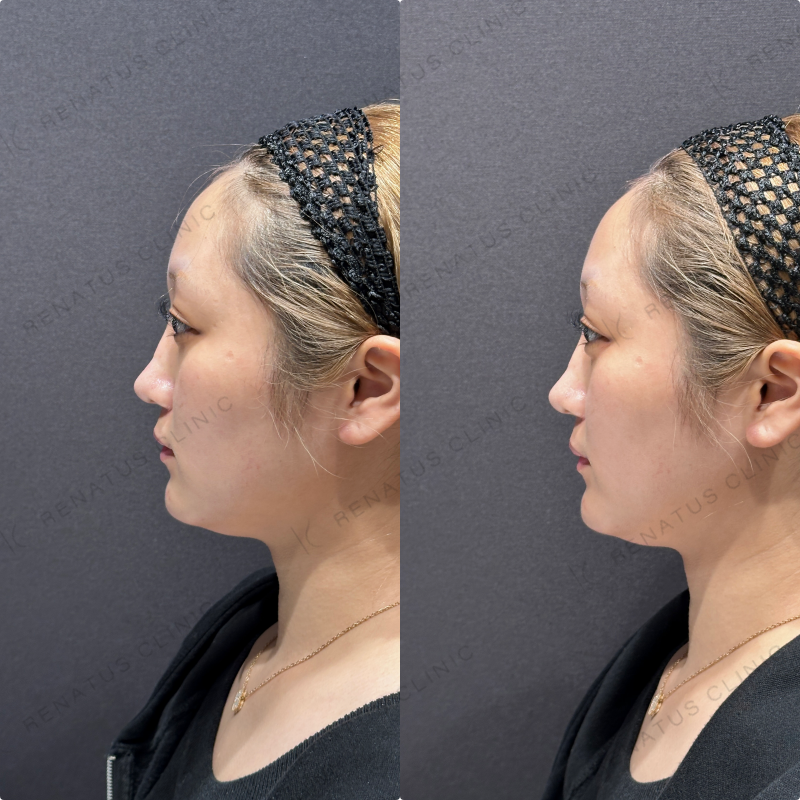 涙袋ヒアルロン酸ボルベラ症例写真