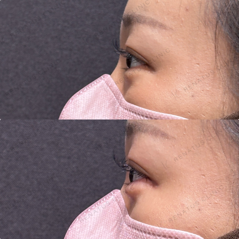 涙袋ヒアルロン酸ボルベラ症例写真