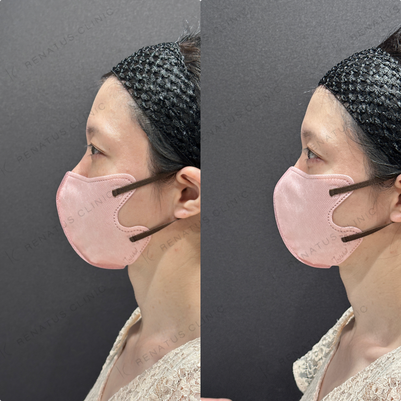 涙袋ヒアルロン酸ボルベラ症例写真