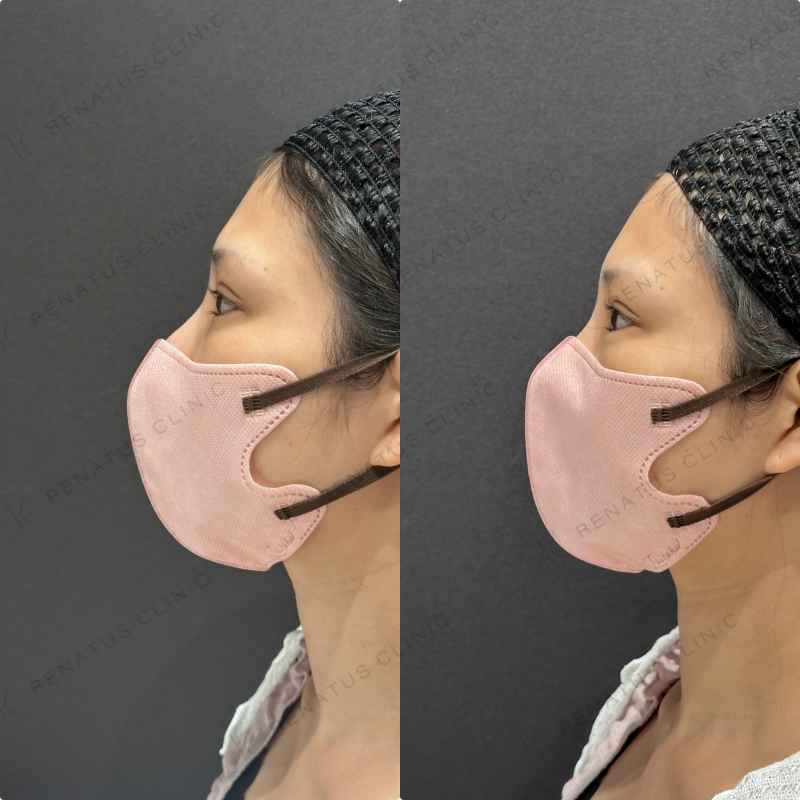 涙袋ヒアルロン酸ボルベラ症例写真