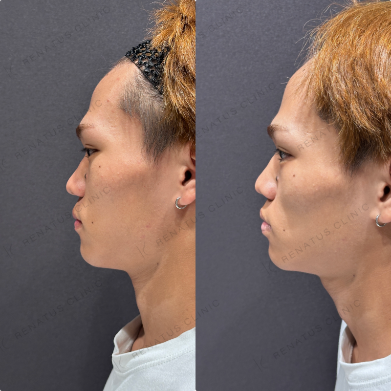 涙袋ヒアルロン酸ボルベラ症例写真