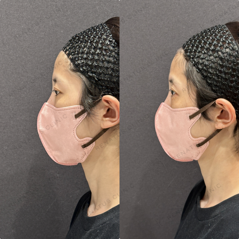 涙袋ヒアルロン酸ボルベラ症例写真