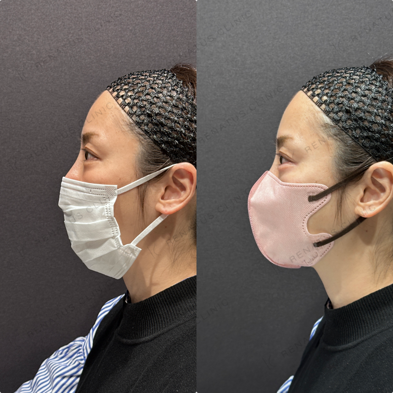 涙袋ヒアルロン酸ボルベラ症例写真