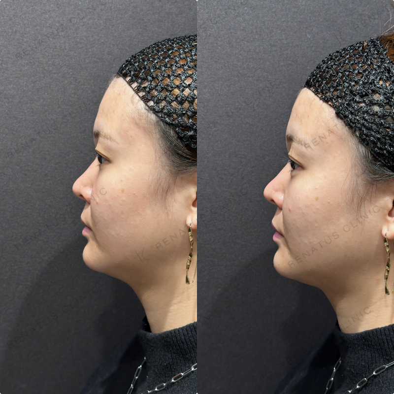 涙袋ヒアルロン酸ボルベラ症例写真