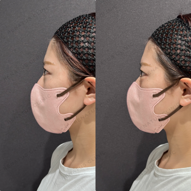 涙袋ヒアルロン酸ボルベラ症例写真