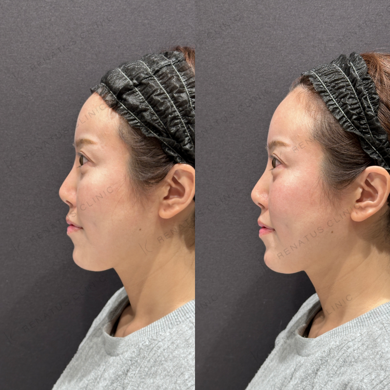 涙袋ヒアルロン酸ボルベラ症例写真