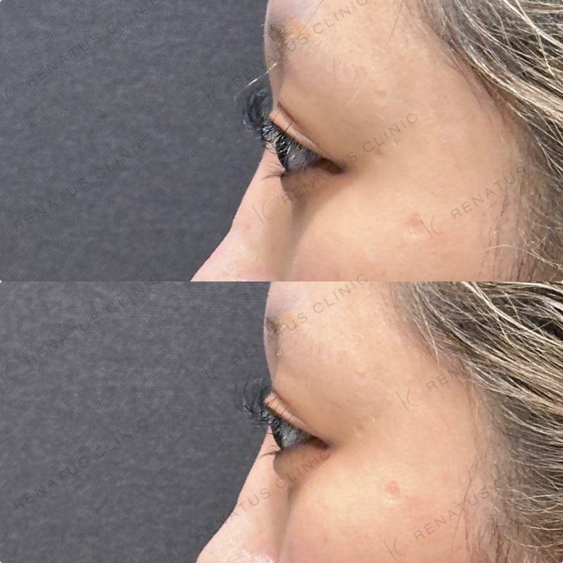 涙袋ヒアルロン酸ボルベラ症例写真