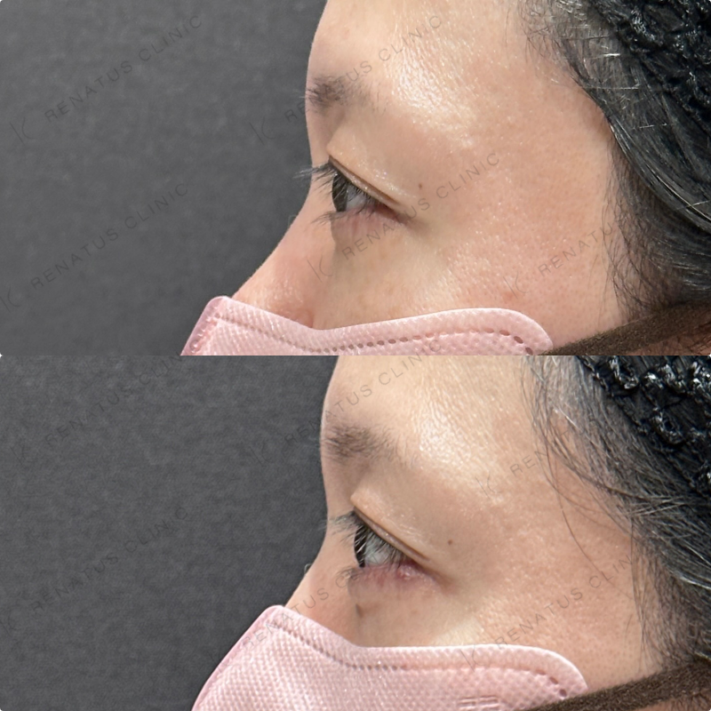 涙袋ヒアルロン酸ボルベラ症例写真