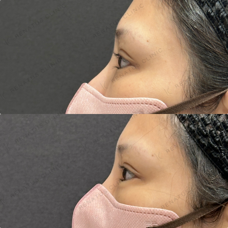 涙袋ヒアルロン酸ボルベラ症例写真