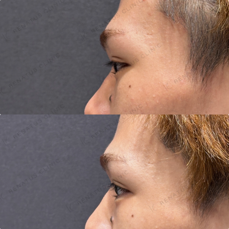 涙袋ヒアルロン酸ボルベラ症例写真