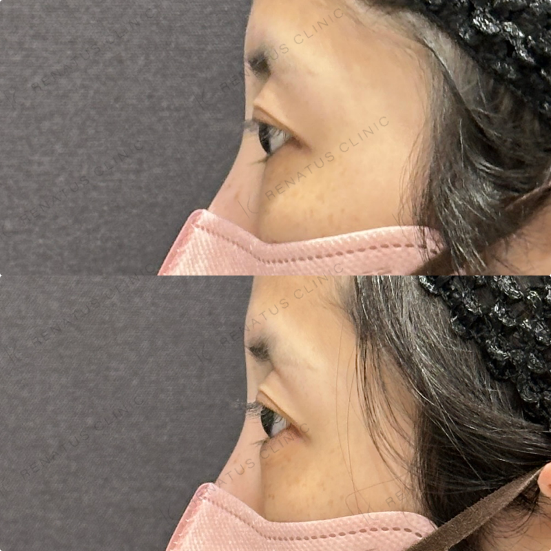 涙袋ヒアルロン酸ボルベラ症例写真