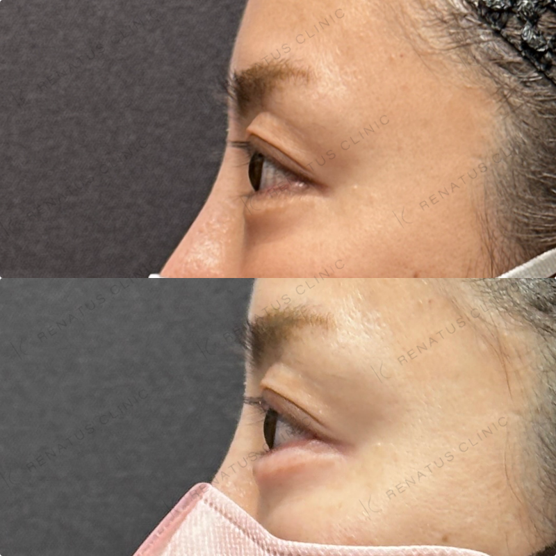 涙袋ヒアルロン酸ボルベラ症例写真