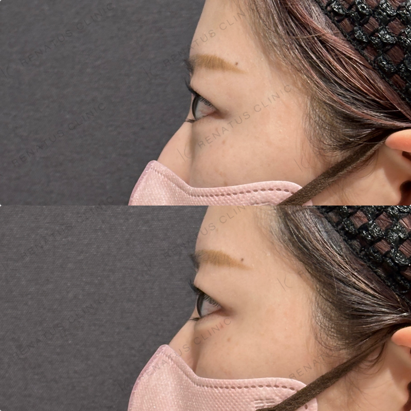 涙袋ヒアルロン酸ボルベラ症例写真