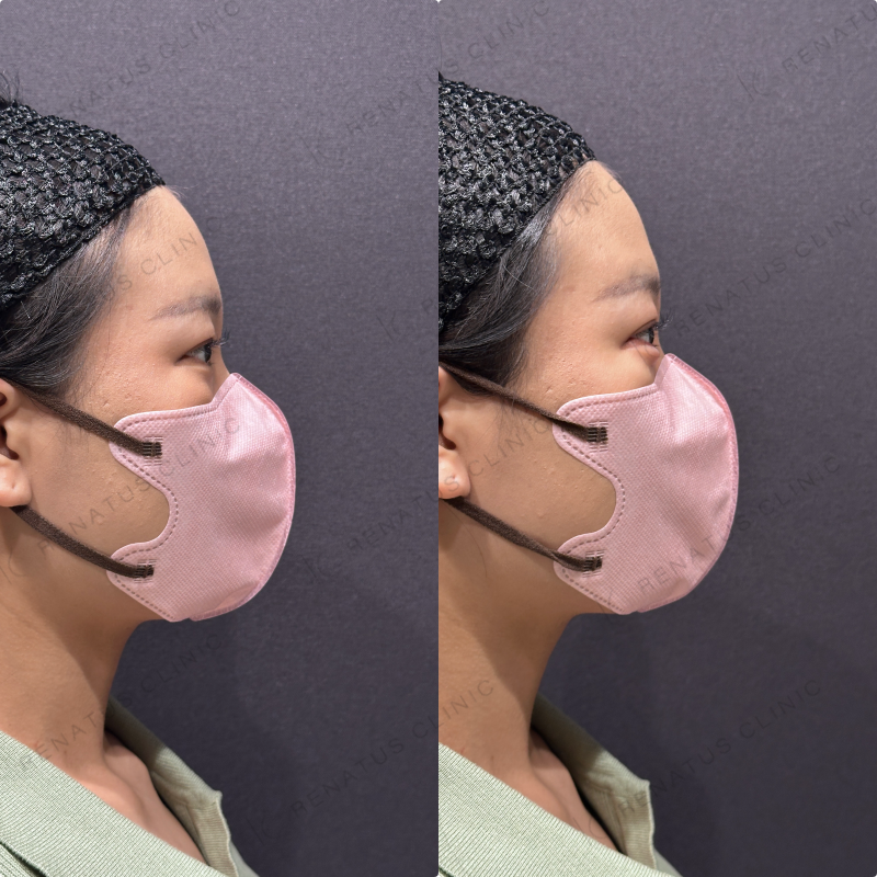 涙袋ヒアルロン酸ボルベラ症例写真