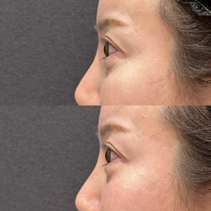 涙袋ヒアルロン酸ボルベラ症例写真