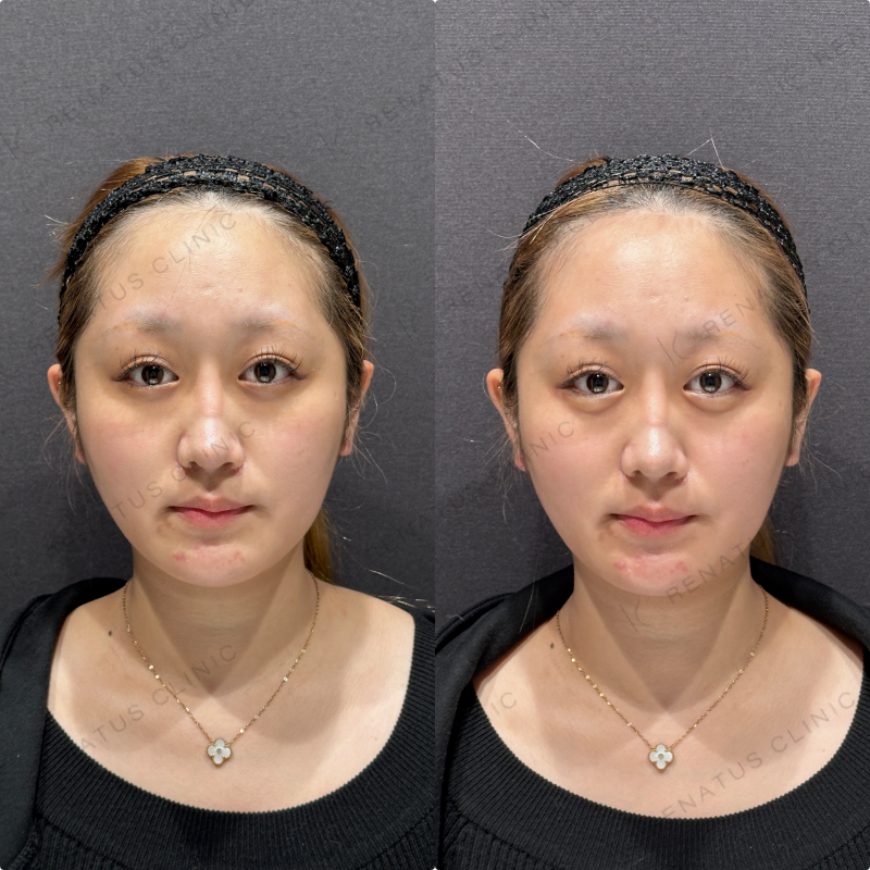 涙袋ヒアルロン酸ボルベラ症例写真