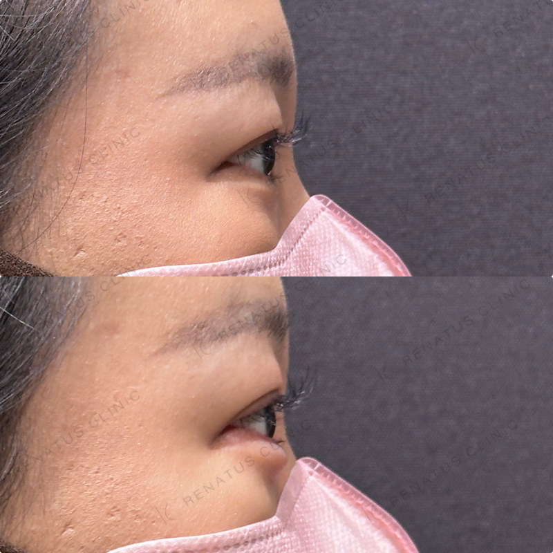 涙袋ヒアルロン酸ボルベラ症例写真