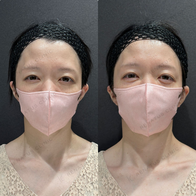 涙袋ヒアルロン酸ボルベラ症例写真