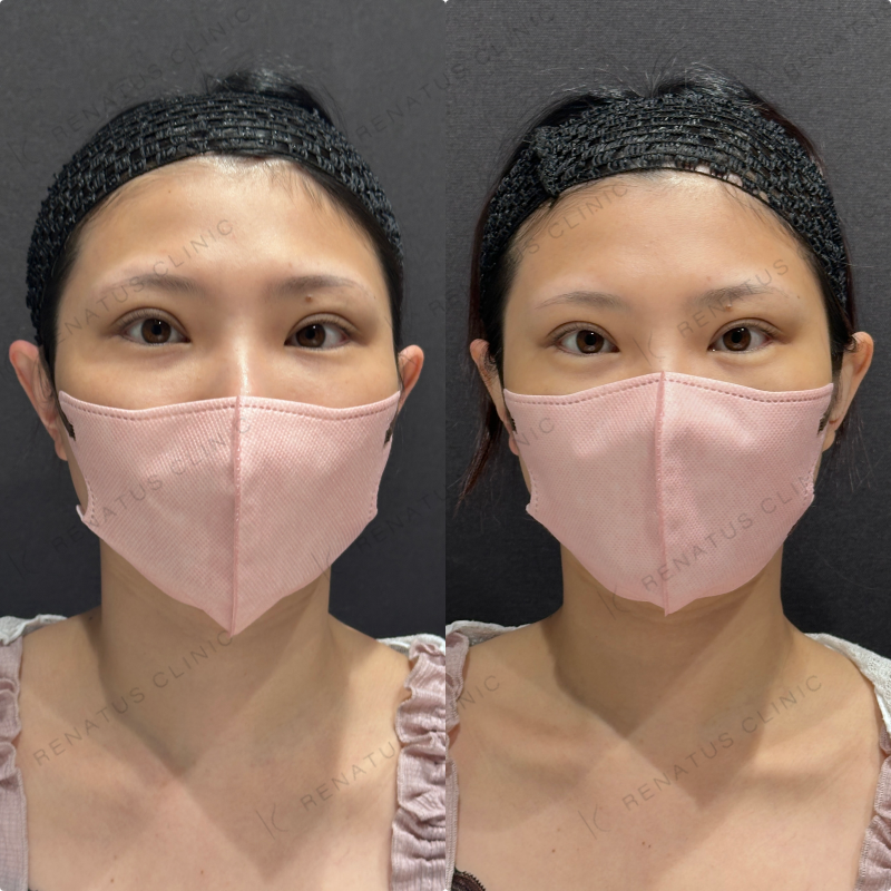 涙袋ヒアルロン酸ボルベラ症例写真