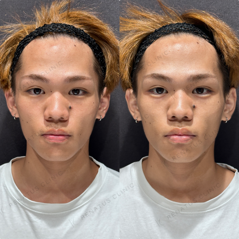 涙袋ヒアルロン酸ボルベラ症例写真