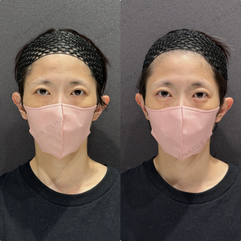 涙袋ヒアルロン酸ボルベラ症例写真