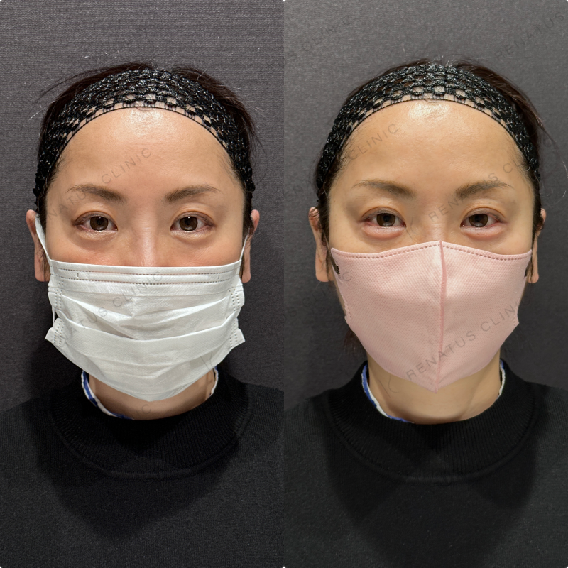 涙袋ヒアルロン酸ボルベラ症例写真