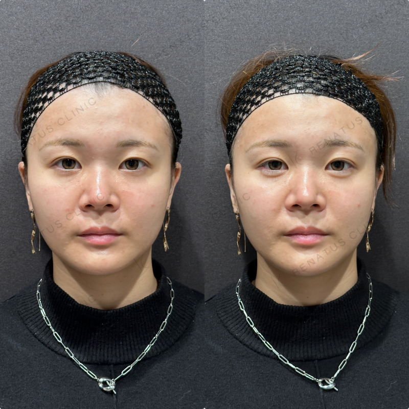 涙袋ヒアルロン酸ボルベラ症例写真