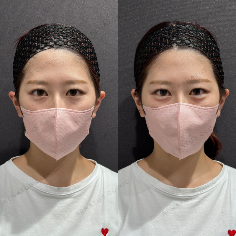 涙袋ヒアルロン酸ボルベラ症例写真