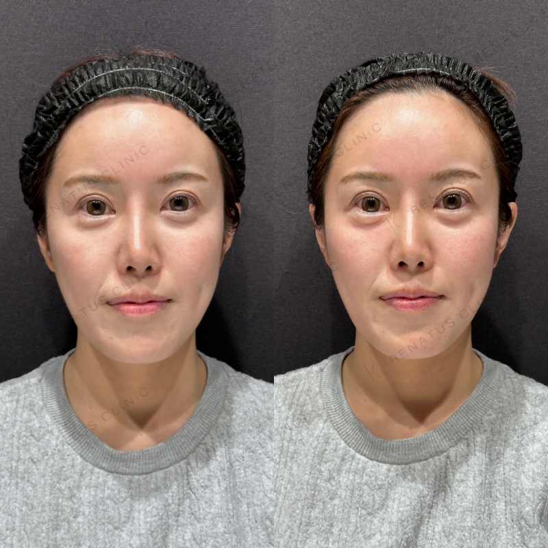 涙袋ヒアルロン酸ボルベラ症例写真