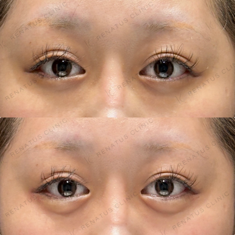 涙袋ヒアルロン酸ボルベラ症例写真