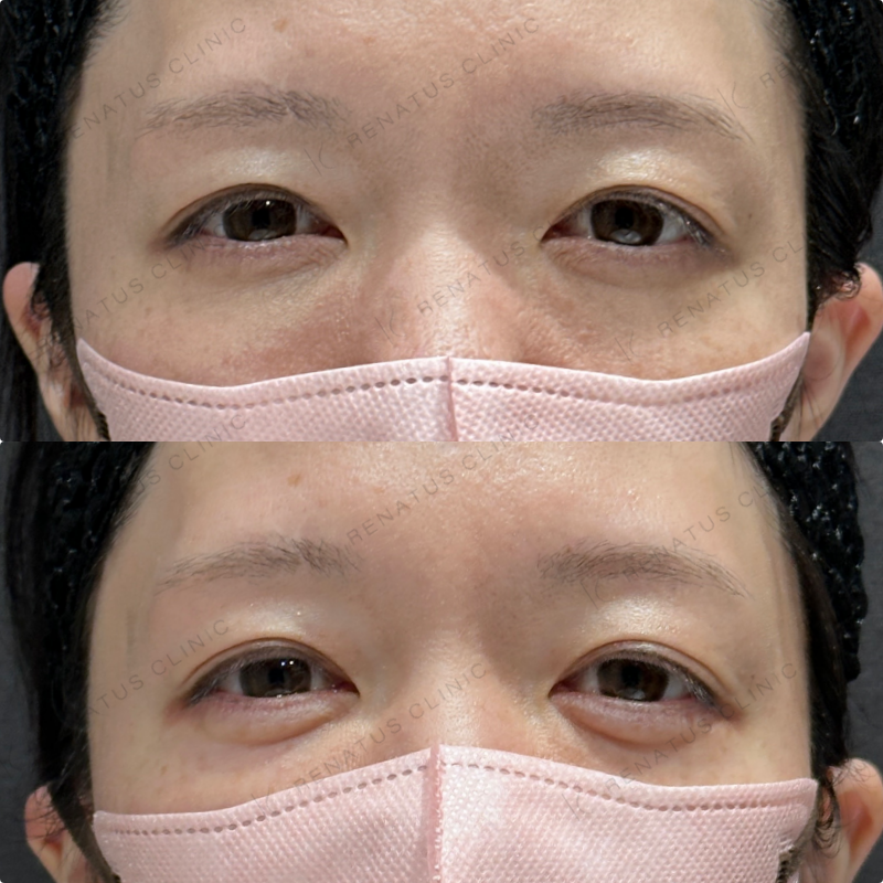 涙袋ヒアルロン酸ボルベラ症例写真