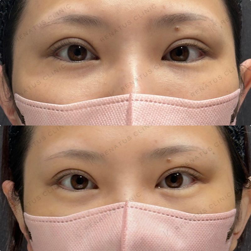 涙袋ヒアルロン酸ボルベラ症例写真