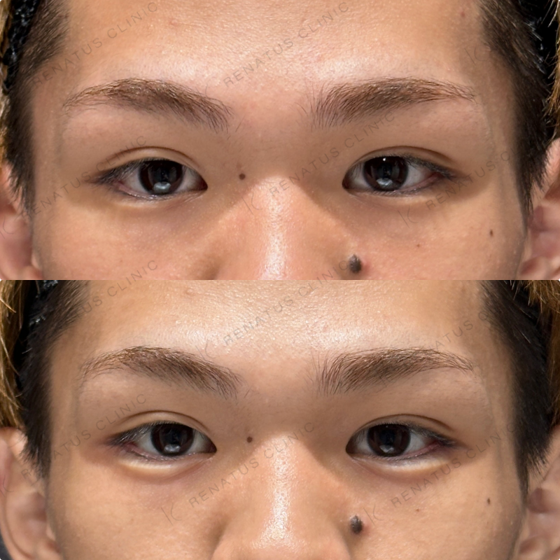 涙袋ヒアルロン酸ボルベラ症例写真