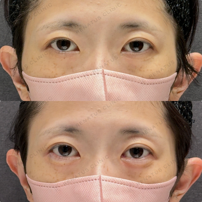 涙袋ヒアルロン酸ボルベラ症例写真