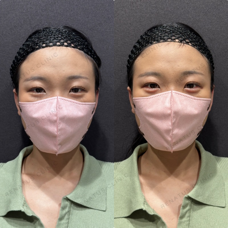 涙袋ヒアルロン酸ボルベラ症例写真