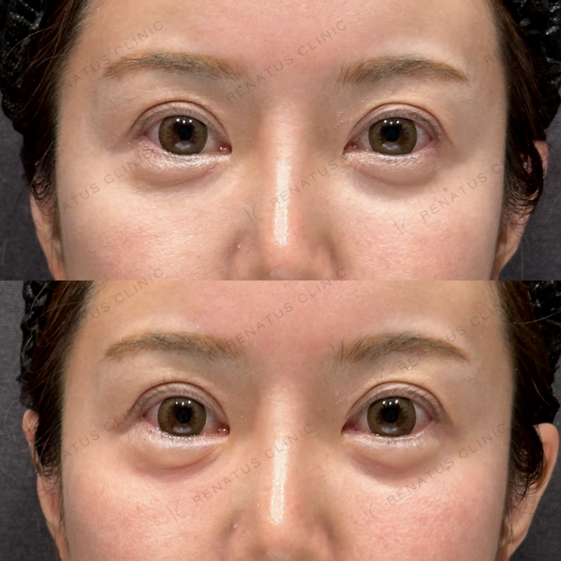 涙袋ヒアルロン酸ボルベラ症例写真