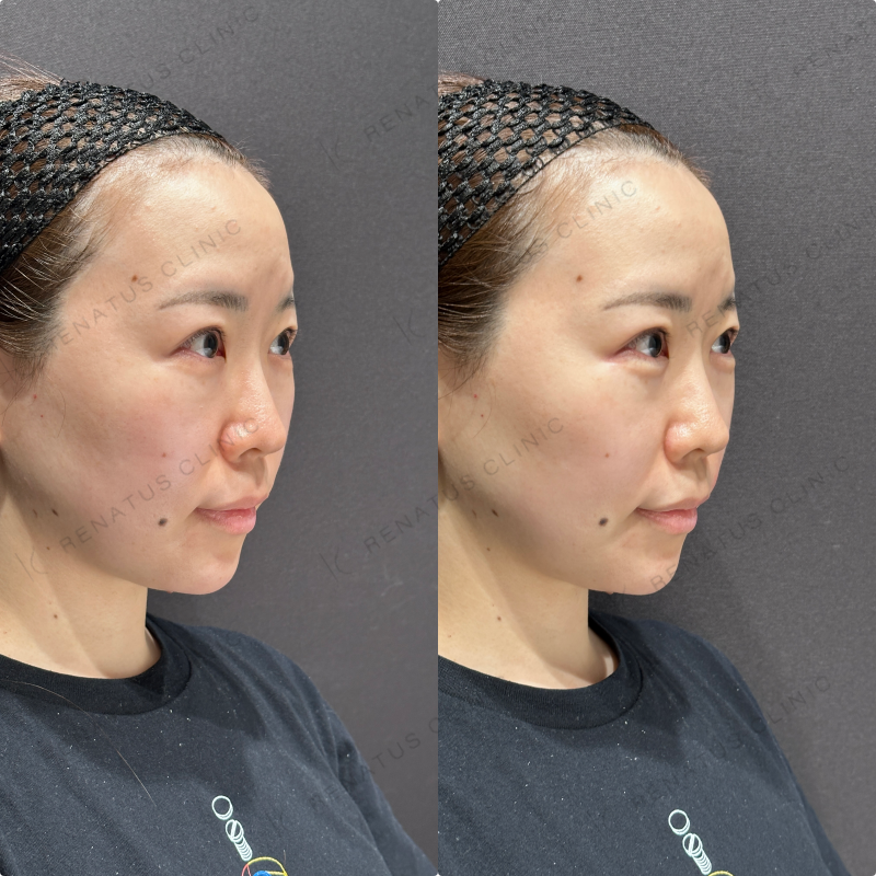 涙袋・ほうれい線ヒアルロン酸ボルベラ・ダイヤモンドフィール症例写真