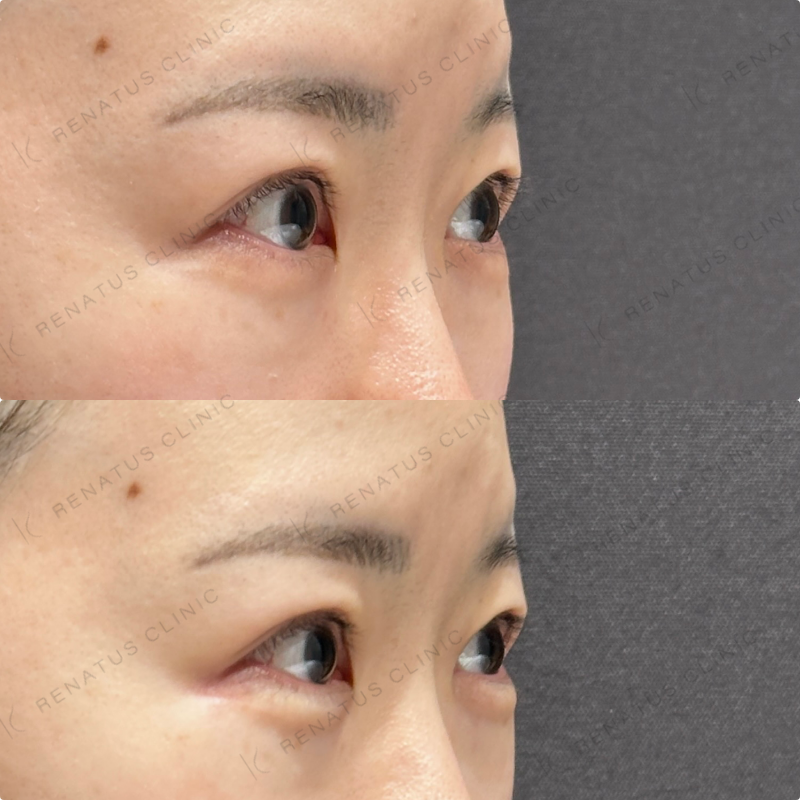 涙袋・ほうれい線ヒアルロン酸ボルベラ・ダイヤモンドフィール症例写真