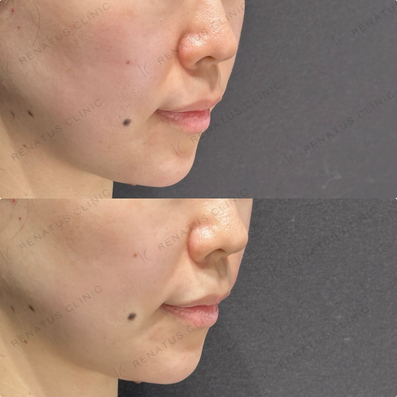 涙袋・ほうれい線ヒアルロン酸ボルベラ・ダイヤモンドフィール症例写真