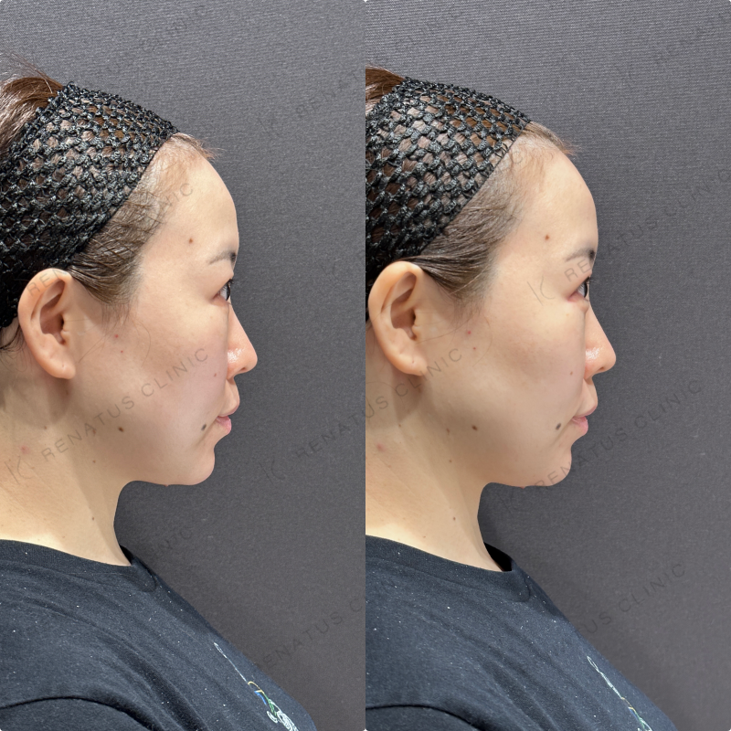 涙袋・ほうれい線ヒアルロン酸ボルベラ・ダイヤモンドフィール症例写真