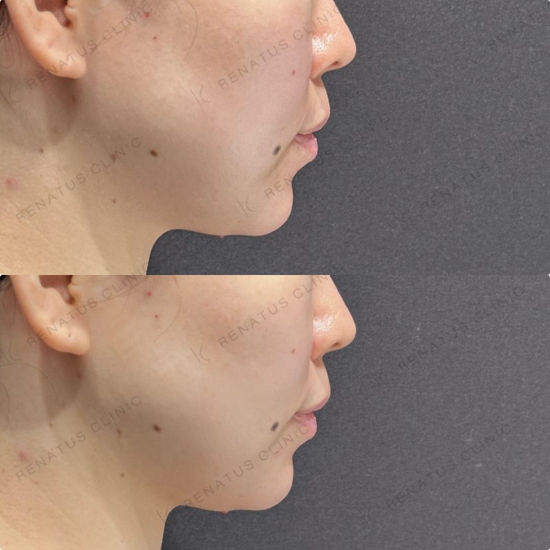 涙袋・ほうれい線ヒアルロン酸ボルベラ・ダイヤモンドフィール症例写真