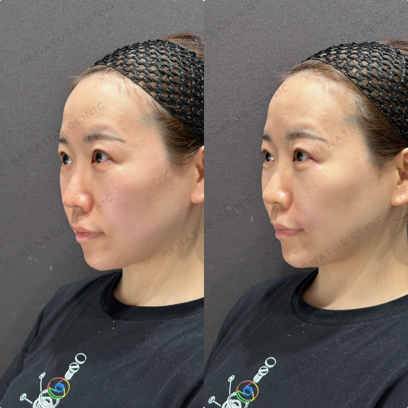 涙袋・ほうれい線ヒアルロン酸ボルベラ・ダイヤモンドフィール症例写真