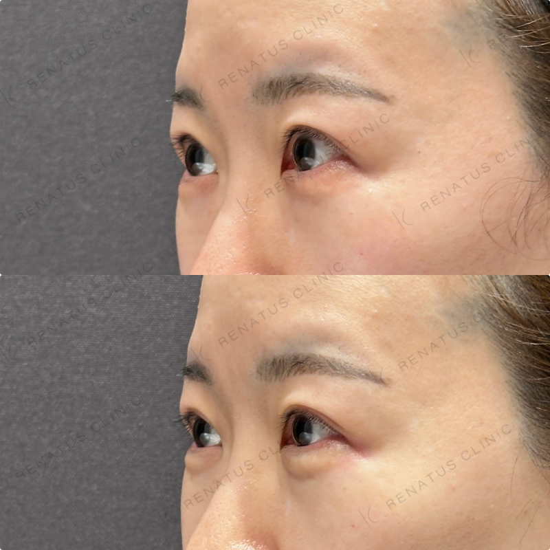 涙袋・ほうれい線ヒアルロン酸ボルベラ・ダイヤモンドフィール症例写真