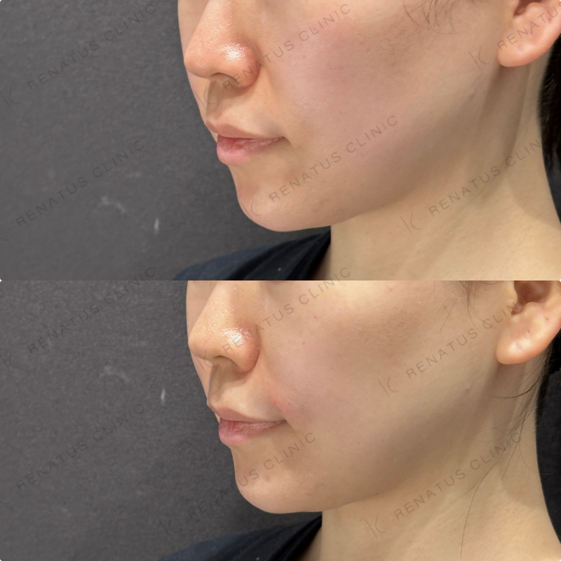 涙袋・ほうれい線ヒアルロン酸ボルベラ・ダイヤモンドフィール症例写真