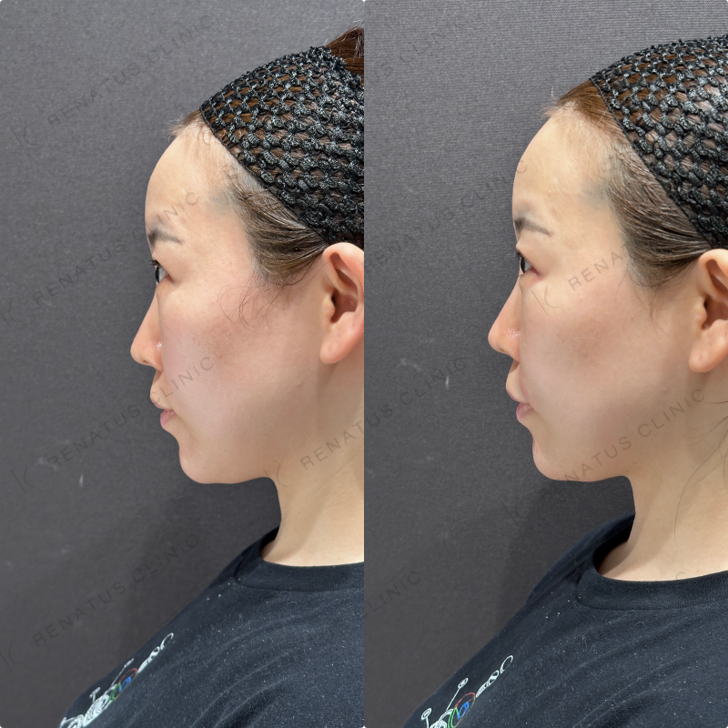 涙袋・ほうれい線ヒアルロン酸ボルベラ・ダイヤモンドフィール症例写真