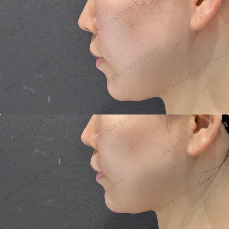 涙袋・ほうれい線ヒアルロン酸ボルベラ・ダイヤモンドフィール症例写真