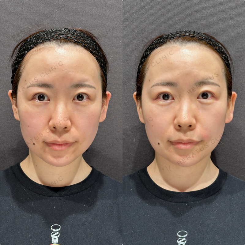 涙袋・ほうれい線ヒアルロン酸ボルベラ・ダイヤモンドフィール症例写真